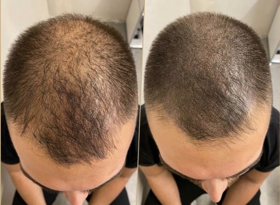 Haarpigmentierung im Studio