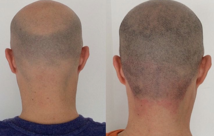 Bart- und Haarpigmentierung Behandlung